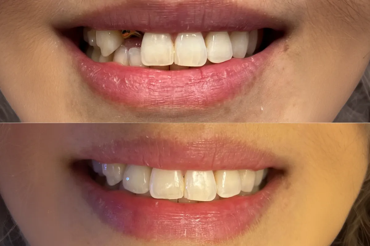img protect damaged teeth before they get worse