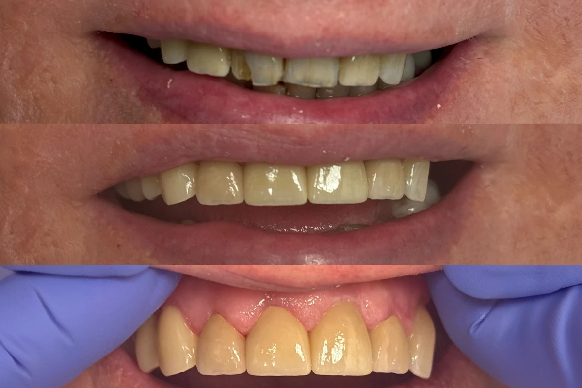 img restore what missing teeth have taken away